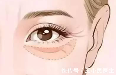 王小民 王小民教授：很多人年纪轻轻就有了眼袋，该怎么办？
