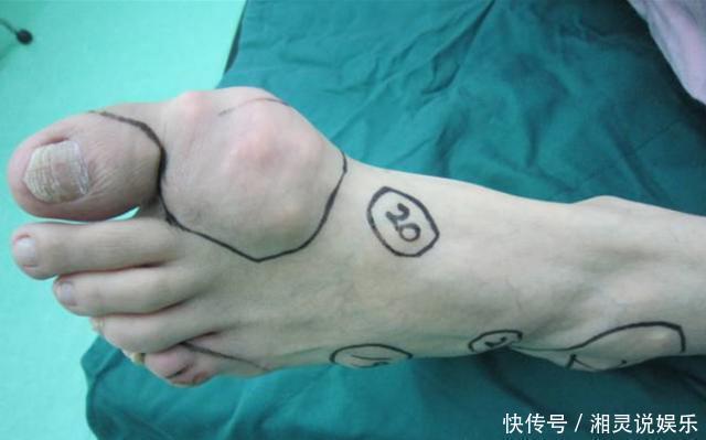 王被|真正的嘌呤王被找到，比猪肉的嘌呤含量高40倍，劝你管住嘴