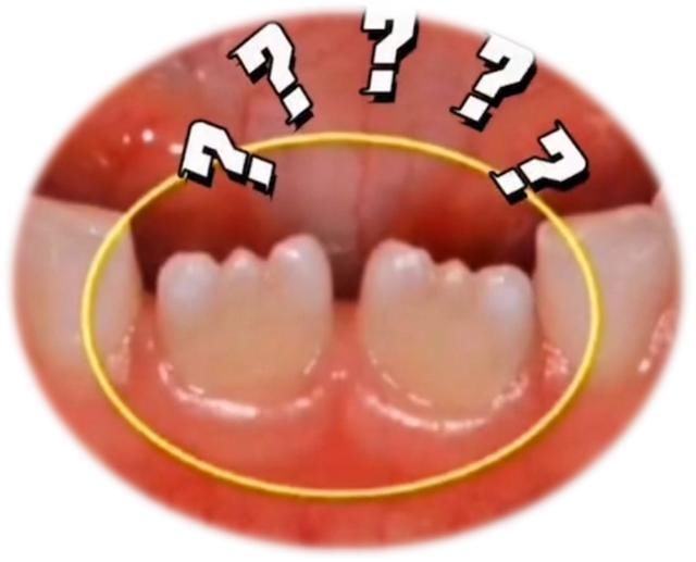 崔彦|为何宝宝新出的牙齿上有很多小锯齿？