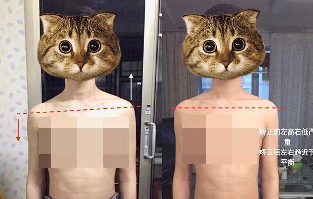 宝宝|4个月宝宝被查出“脊柱变形”,只因妈妈带他出门时,总爱这么做