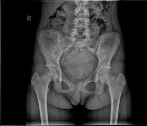 椎体|脊柱常见肿瘤及肿瘤样病变的几种影像学表现，你都见过吗？