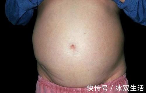 腹水|闻癌色变?可能可怕的不是癌症本身,这些并发症才是真正的“致命凶手”