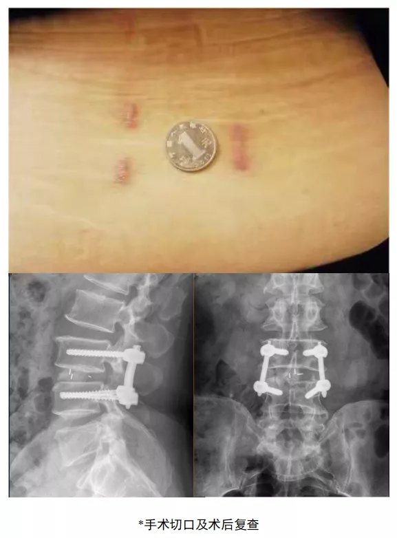 通道|“管中窥豹”，微创通道精准治疗腰椎病变