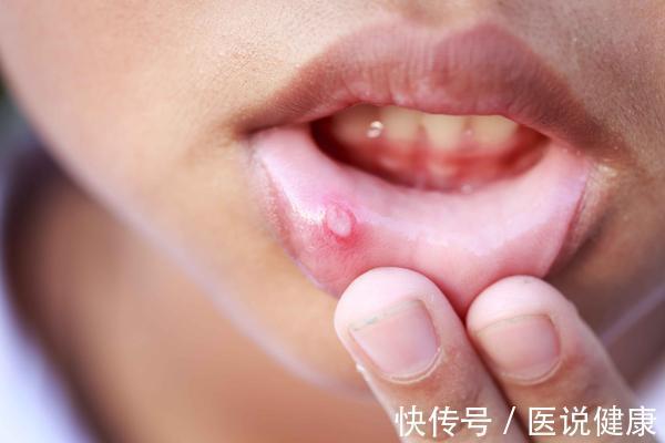 癌细胞|口腔癌发生时，身体或有6种表现，发现后，及时检查，别轻视