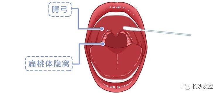 长沙|核酸检测为什么要采口鼻，不能采耳？长沙疾控专家告诉你原因