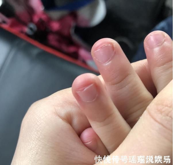 甲沟炎|研究发现:爱咬指甲的孩子,都逃不过这5种结局!