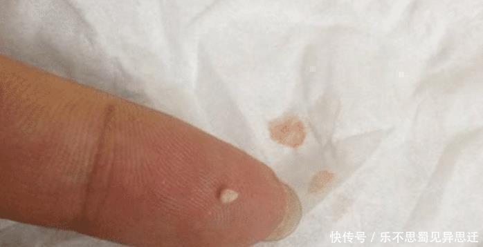 油脂粒 抿紧下巴后突起的“白疙瘩”,千万要注意,这是螨虫的真身吗!