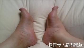 水肿|一个很奇效的方子，服用一周，全身的水肿和积液全不见了