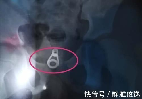 膀胱|为救六岁女童医生小心翼翼，家长一定不要额外损伤