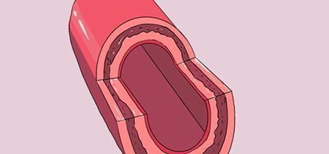  体质|结节体质的人，医生总结出几个“共性”，若你一个没有，值得庆幸