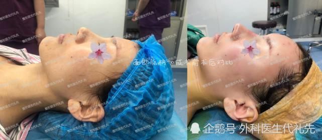 苹果肌|做脂肪填充之后,会下垂得更厉害?更容易显老?准备做面填的人来看看