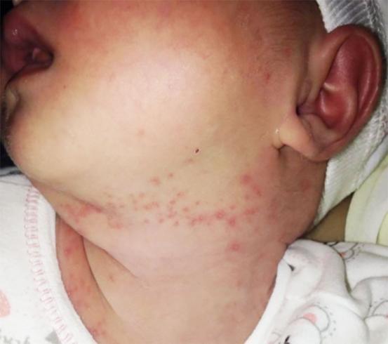 行为|儿科医生奉劝不想宝宝总被湿疹折腾,妈妈5个行为少对宝宝做