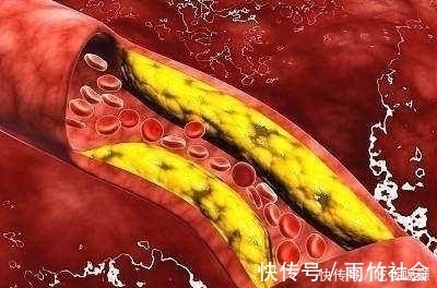 食物|血管一年比一年堵 这些食物, 每天吃一点,让血管一通到底