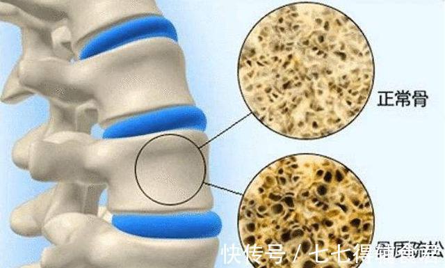 花生|燕麦是骨质疏松的“发物”?医生:不想钙流失,2种食物要少吃