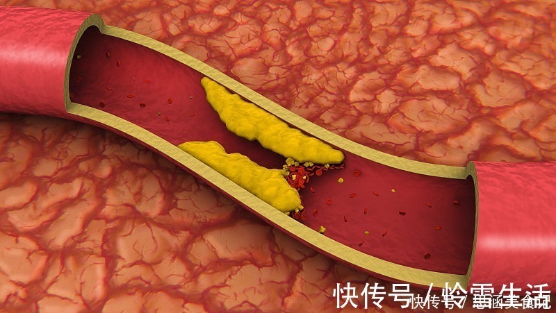 清洁工|血栓的“清洁工”发现了,不是醋,没事喝一喝,血栓“躲着走”