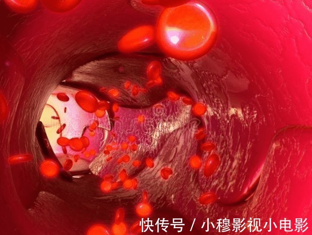 动脉粥样硬化斑块|55岁大叔脑梗离世，妻子嚎啕大哭！医生：一种东西不能天天吃