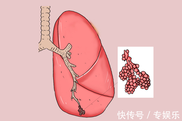 癌变|担心结节迟早要癌变，为什么不尽早切提醒患者，过度医疗不可取