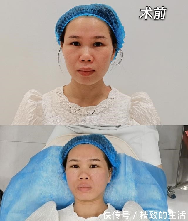 恢复 微针术后7天恢复情况是怎样的!