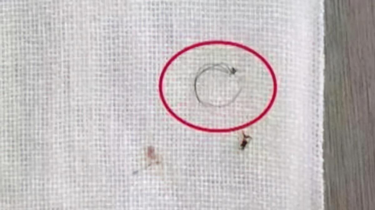 宝宝|1周岁宝宝脚趾进“虫”,宝妈急忙带娃就医,医生:来得及时