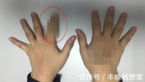 吴德超|得了这病,半岁宝宝脚趾比香蕉还粗!不注意还会复发…