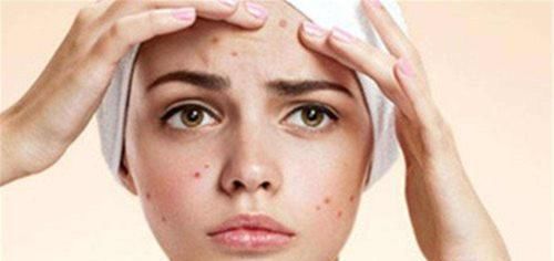 辛辣食物|经常冒痘的人,都有以下3个特征,看看你中了几个