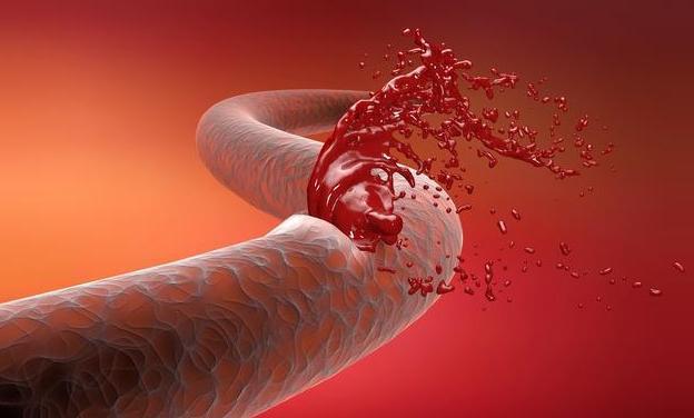 脑梗|天然的“溶栓剂”发现了，早晚温水放几颗，清血管，远离脑梗！