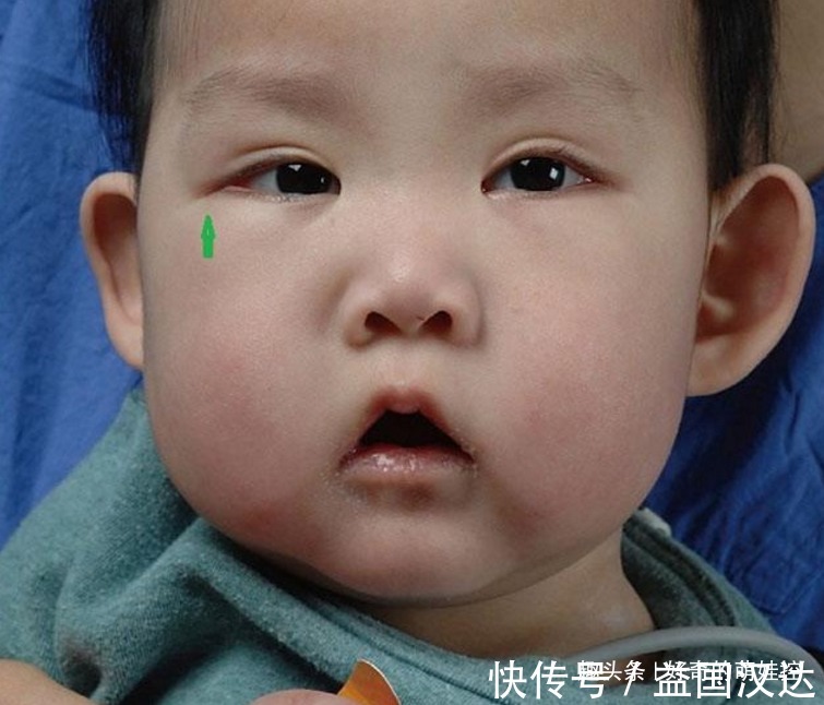 歌舞伎面谱综合征|有一种病叫“孩子太漂亮”,天生自带眼妆,是产检查不出的罕见病