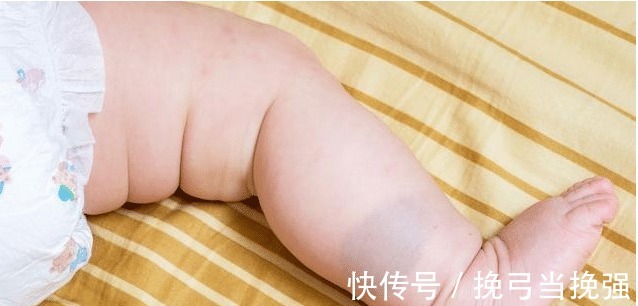 家长|一岁宝宝因“胎记”抢救无效,永远闭上了眼,家长不容忽视!