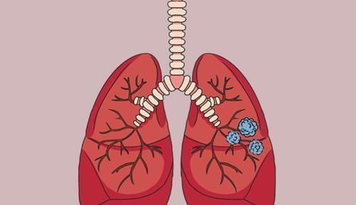 恶性肿瘤|肺结节和肺肿瘤,有什么不一样?医生:3个方面可帮助判断