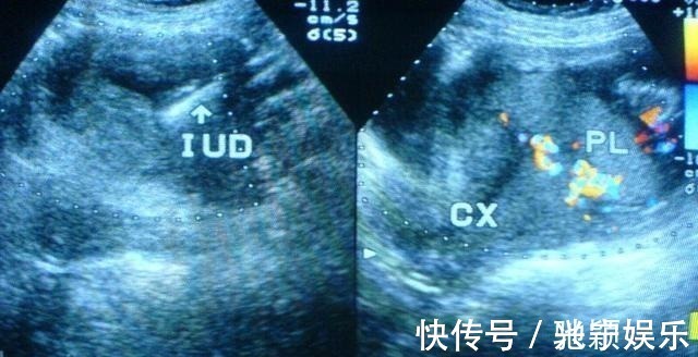 孩子|孕妈生完孩子后要不要上环 看完这4点, 你再做决定吧!