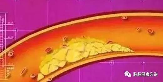  丹参|这个秘方，救了无数心脏病、血管硬化、三高的人，不到五块钱