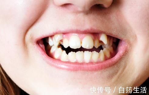 牙齿|孩子换牙齿，新长的牙齿却是歪的，可能是家长这些没做好