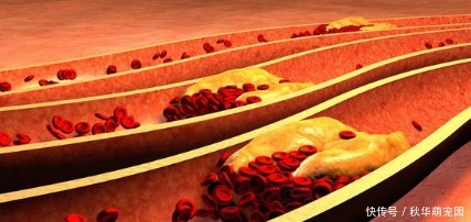 喝茶会加重冠心病还是会减轻冠心病?最新研究给出答案