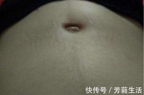 妊娠线|孕妈肚子上的黑线是什么?线在左是男在右是女?原来这么多讲究!
