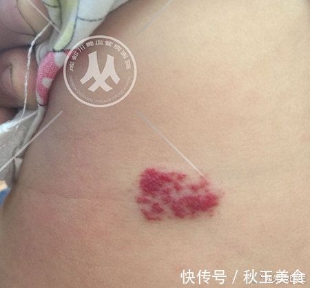 蔓状血管瘤|注意!别忽视,宝宝身上的小红点,可能是血管瘤!