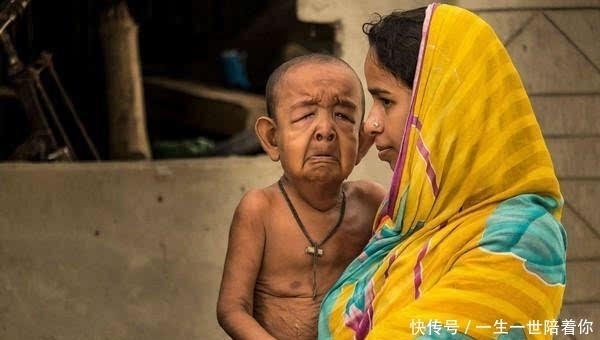 男孩|印度4岁男孩面容如90岁老翁,3个月大牙齿长全