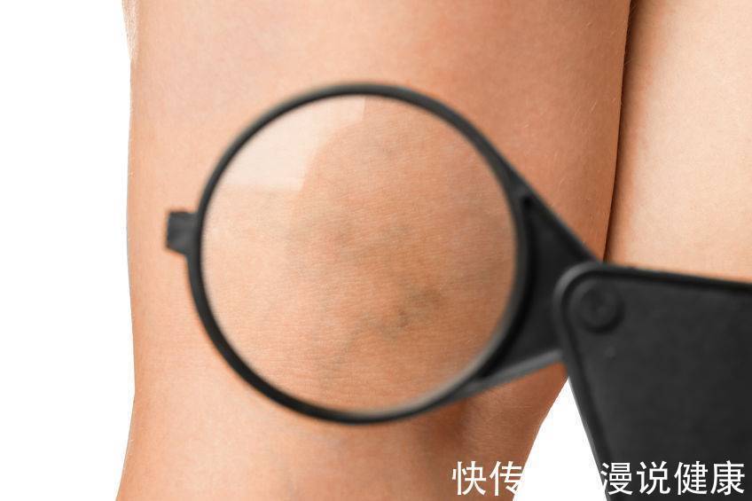 头晕头痛|假期计划要追剧?最新研究:每日追剧4小时,血栓风险提高3倍!