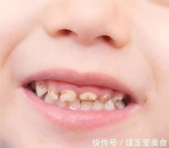 牙齿|为什么越来越多孩子满口黑牙?主因不是糖果,而是无知的父母
