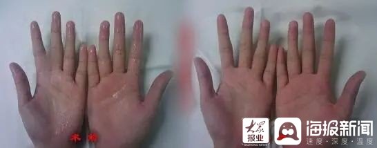 微创|山东大学齐鲁医院(青岛)胸外科微创手术助多例“手汗症”患者摆脱烦恼