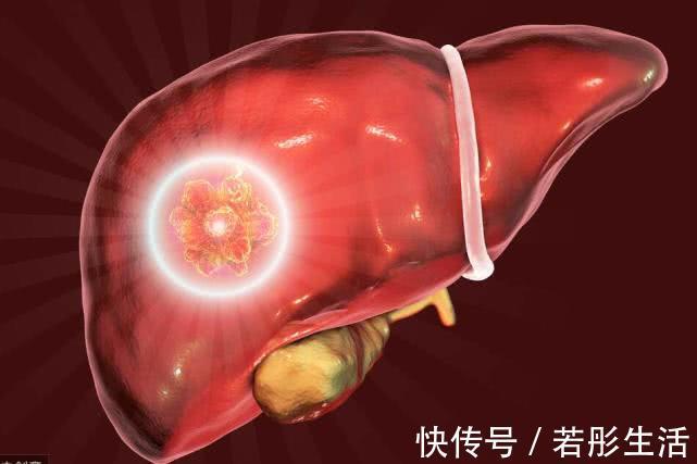 癌前病变|癌症都是拖出来的,再次提醒有4种病,和癌症走得“有点近”