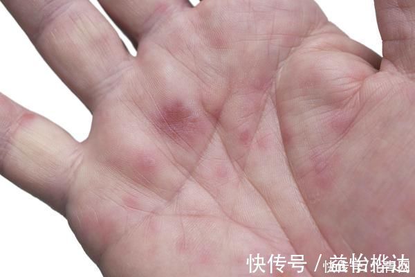 皮肤|皮肤出现4种症状，或是肝出问题了，趁早查一下