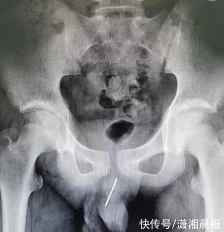 汪俊|9厘米钢针从13岁男孩体内取出!医生:有些教育还是不能少