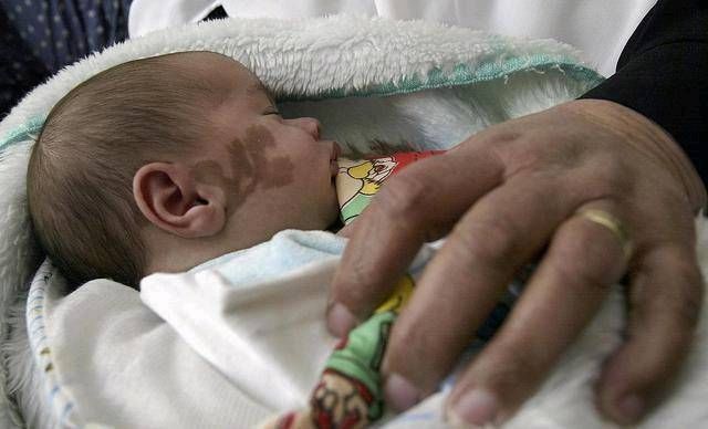 胎记|宝宝出生时脸上有胎记胎记是如何形成的注意怀孕