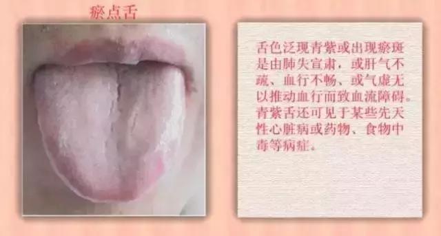 舌诊|中医医生总看舌头都在看什么九种体质+珍贵的舌诊图谱