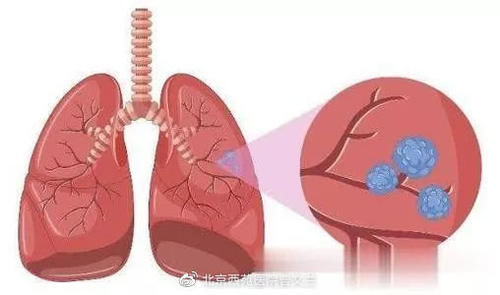 关于肺结节的六连问，带你全面了解肺结节！