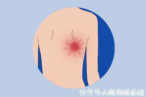 红血丝|肝病会上脸,肝不好的人,脸上通常会有明显的标志,可对照自查