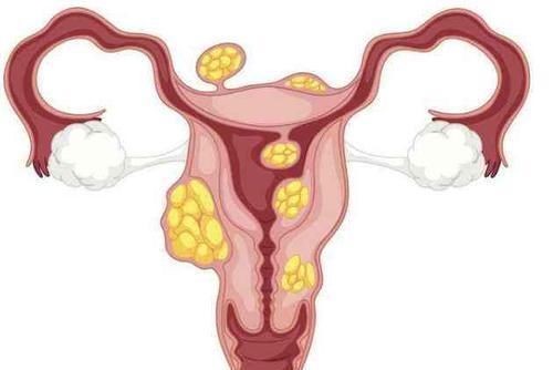 肌瘤|3种女人最容易患子宫肌瘤,尽早预防可以减少肌瘤复发几率