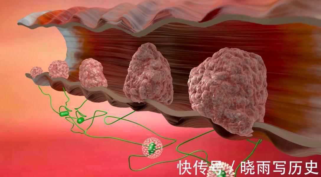 肠壁|如何检查您是否患有直肠癌？