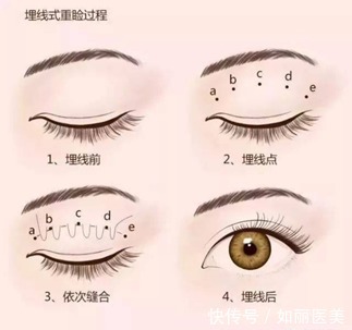 创伤 双眼皮手术方式:埋线、全切、韩式三点怎么选?你的手术方式选对了吗?