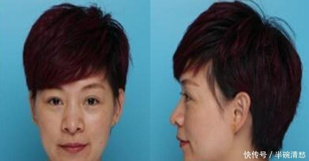 医美医院|那些打过“玻尿酸”的人,容貌会有什么变化还好及时知道了!